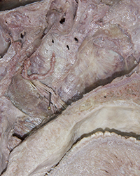 Pterygopalatine Fossa