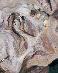 Lateral Tongue