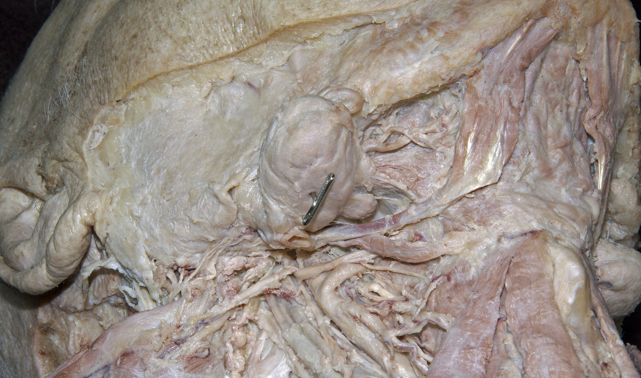 Submandibular Triangle - 3