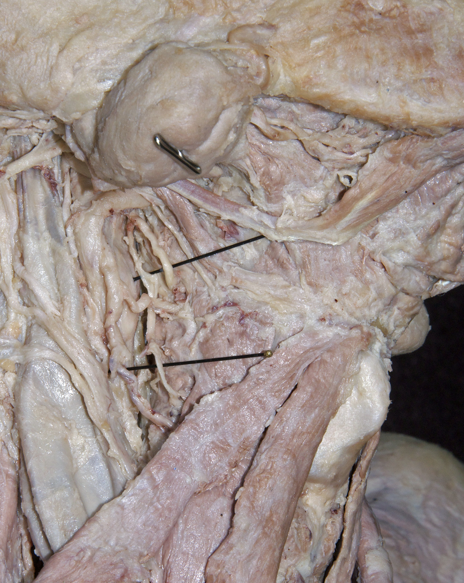 Carotid Triangle - 6