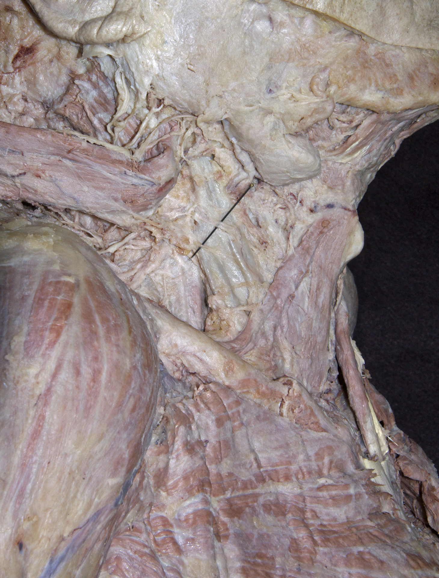 Lateral Neck - 7