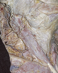 Deep Cervical Lymph Nodes