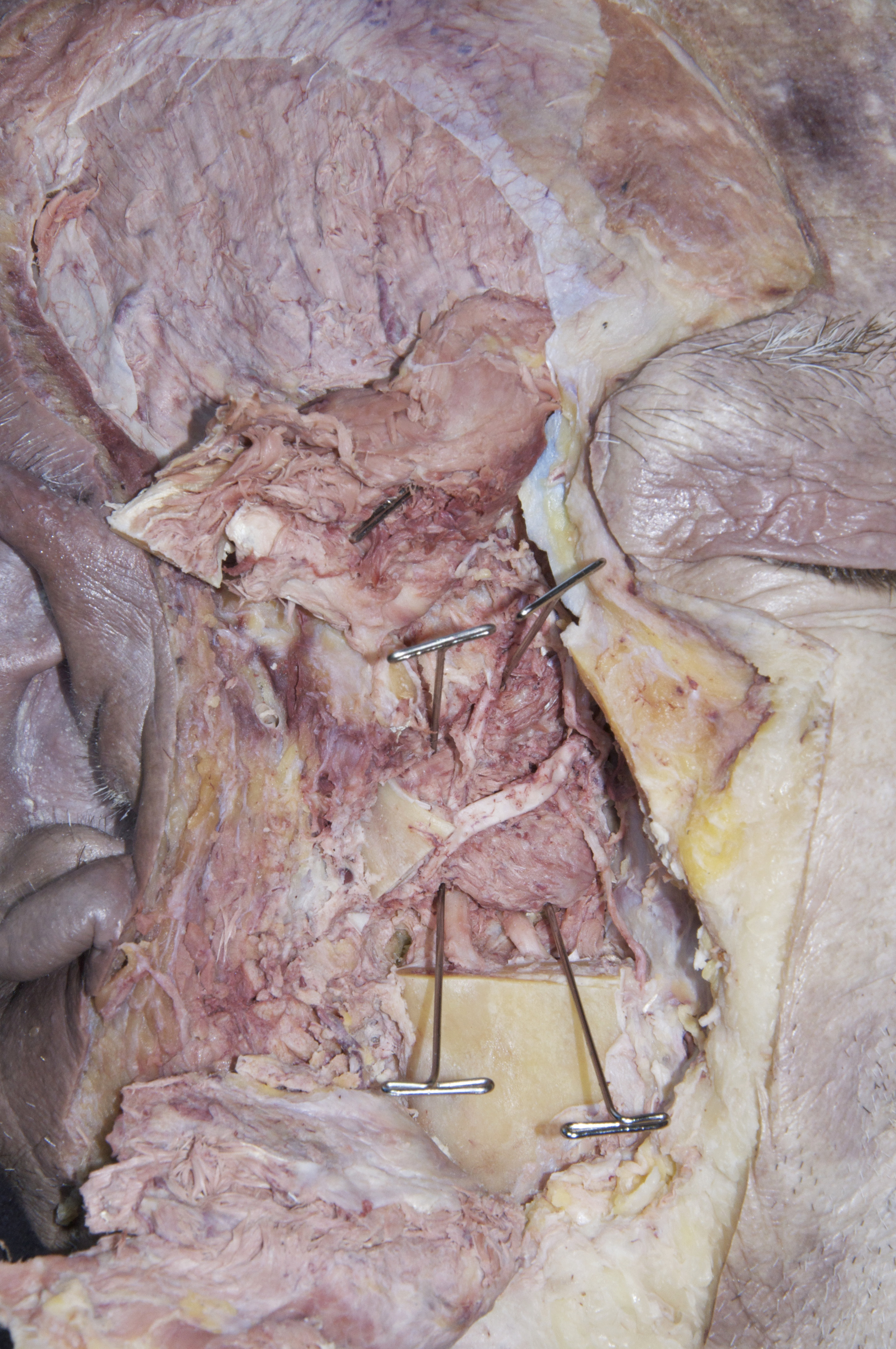 Infratemporal Fossa - 13