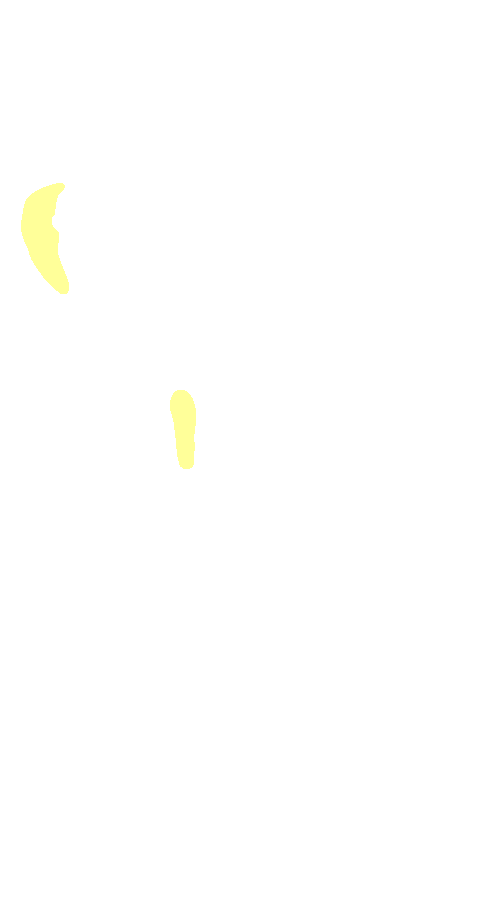 Vastus Medialis