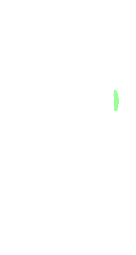 Medial Facet