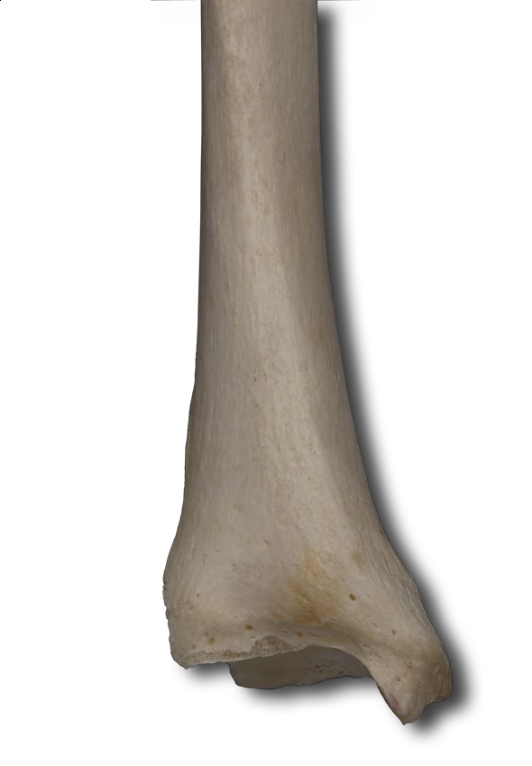 Distal Anterior
