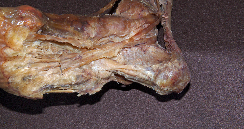 Tibialis Posterior Tendon