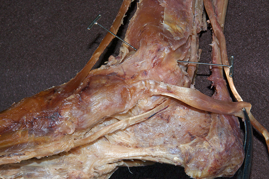 Medial Collateral Ligament