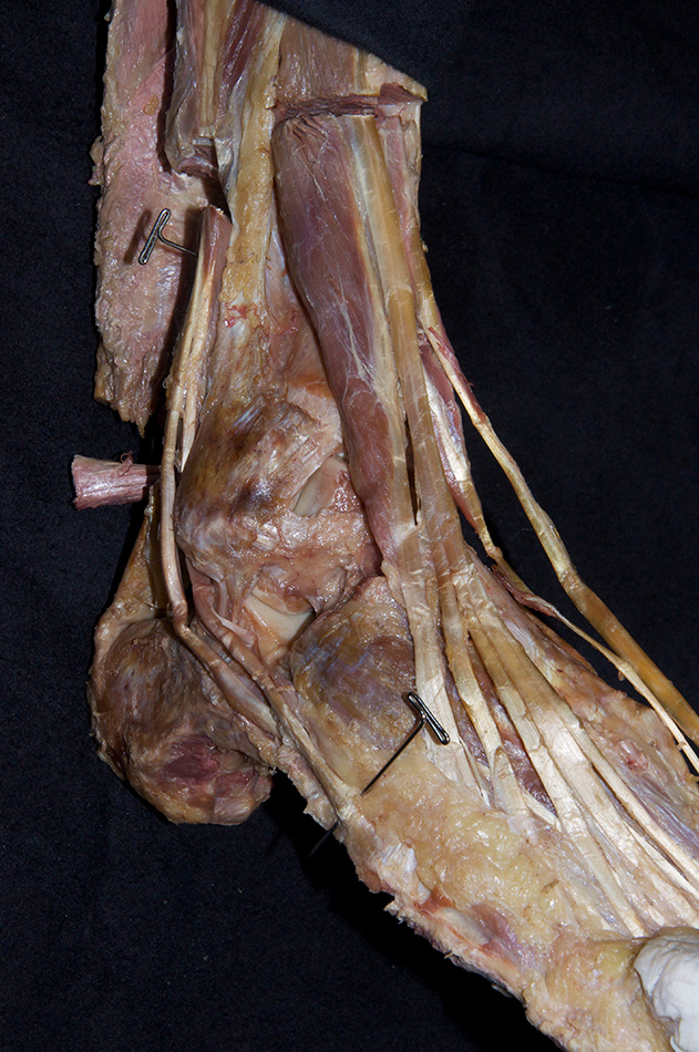 Fibularis Brevis Tendon