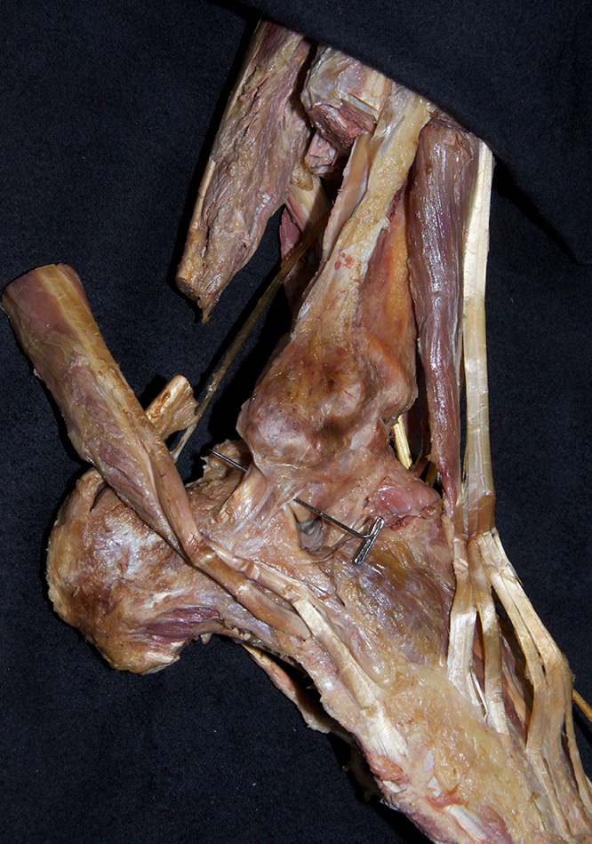 Lateral Collateral Ligament
