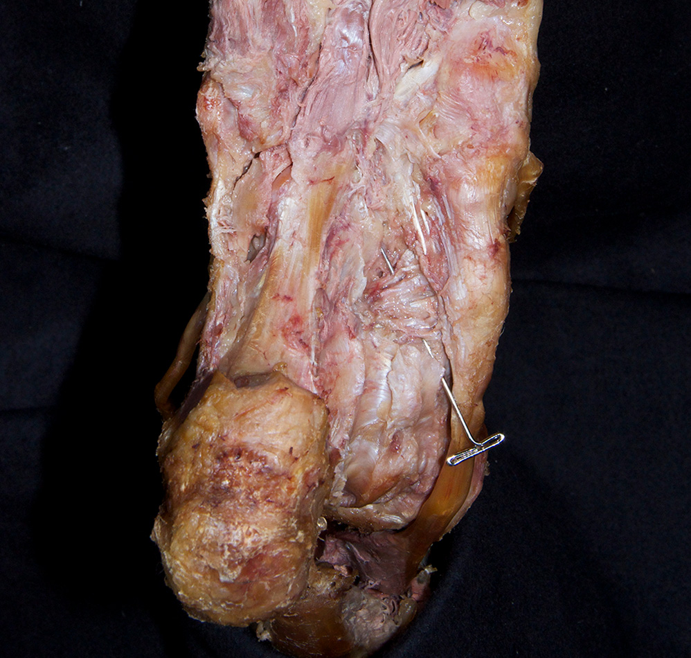 Plantar Calcaneonavicular Ligament