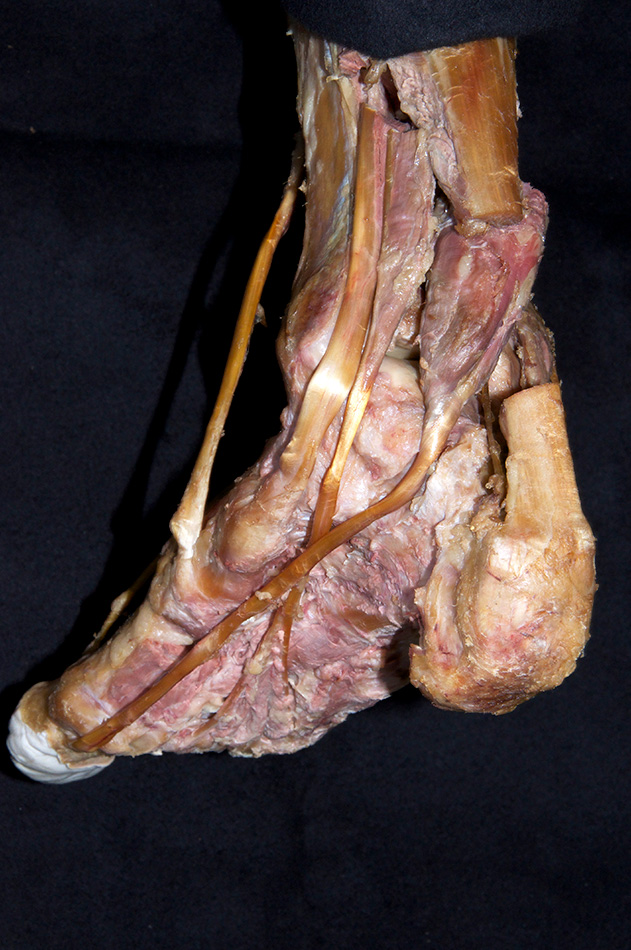Medial Malleolus