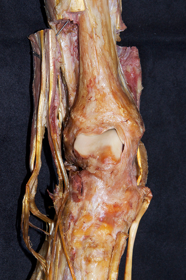 Talus (trochlear surface)