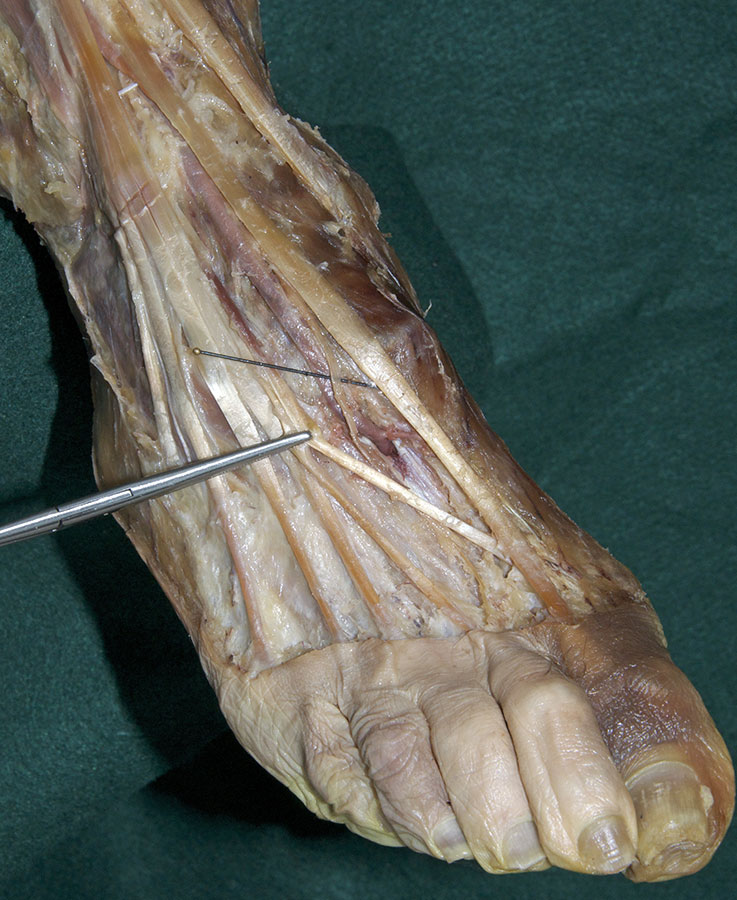 Deep Plantar Artery