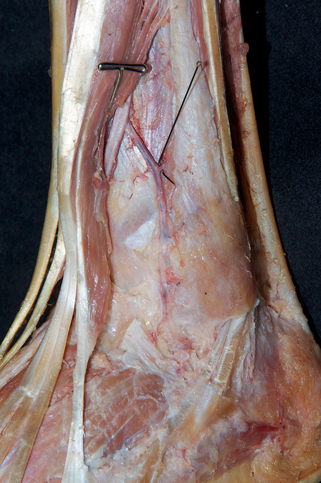 Perforating Branch of Fibular Artery