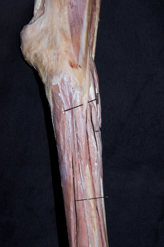 Common Fibular Nerve