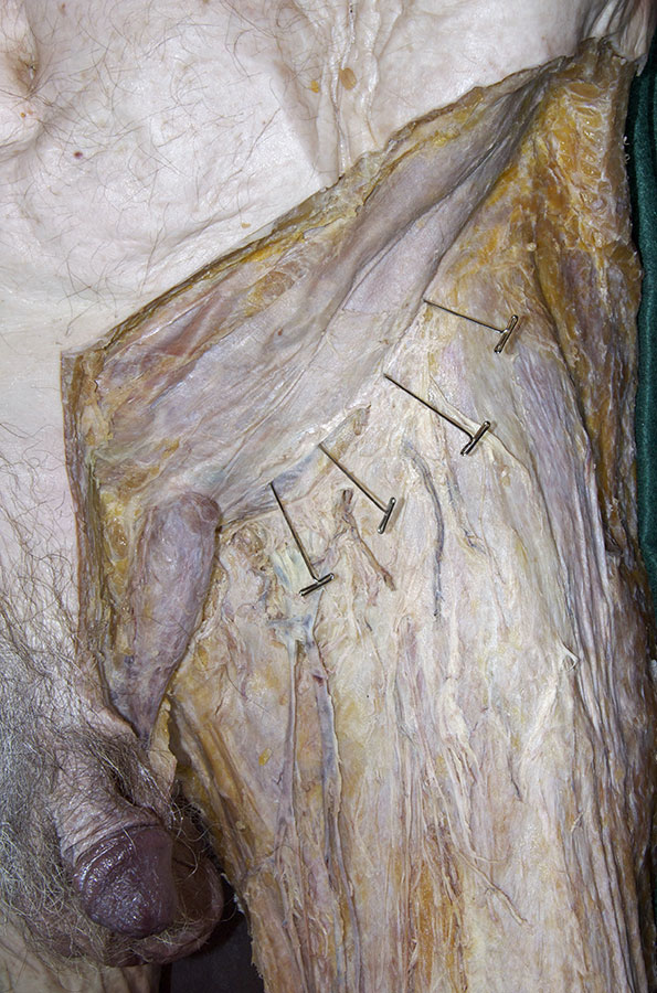 Inguinal Ligament