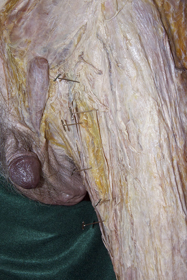 Opening the Fascia Lata