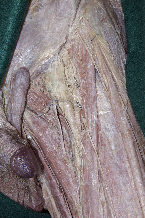 Femoral Sheath