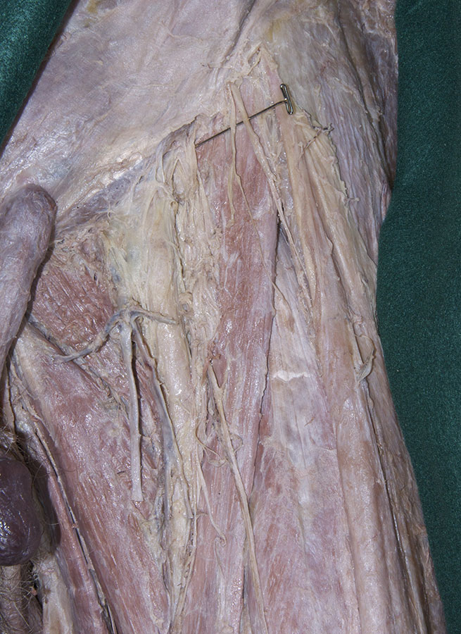 Lateral Cutaneous Nerve of Thigh