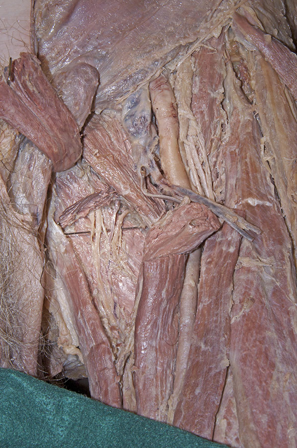 Left Obturator Artery