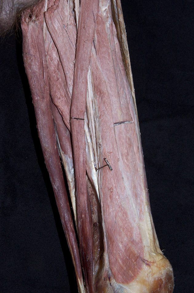 Adductor Magnus Muscle