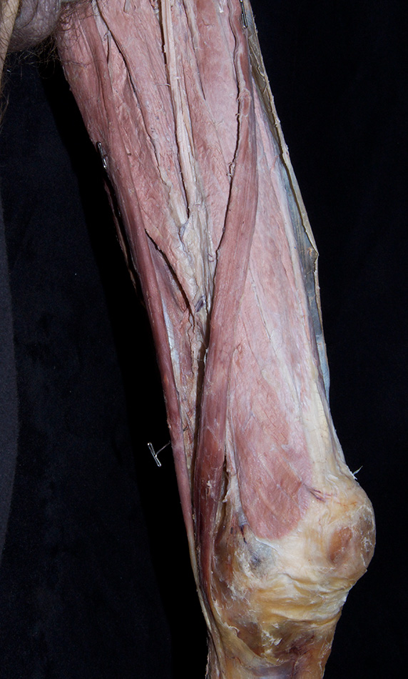 Gracilis Muscle