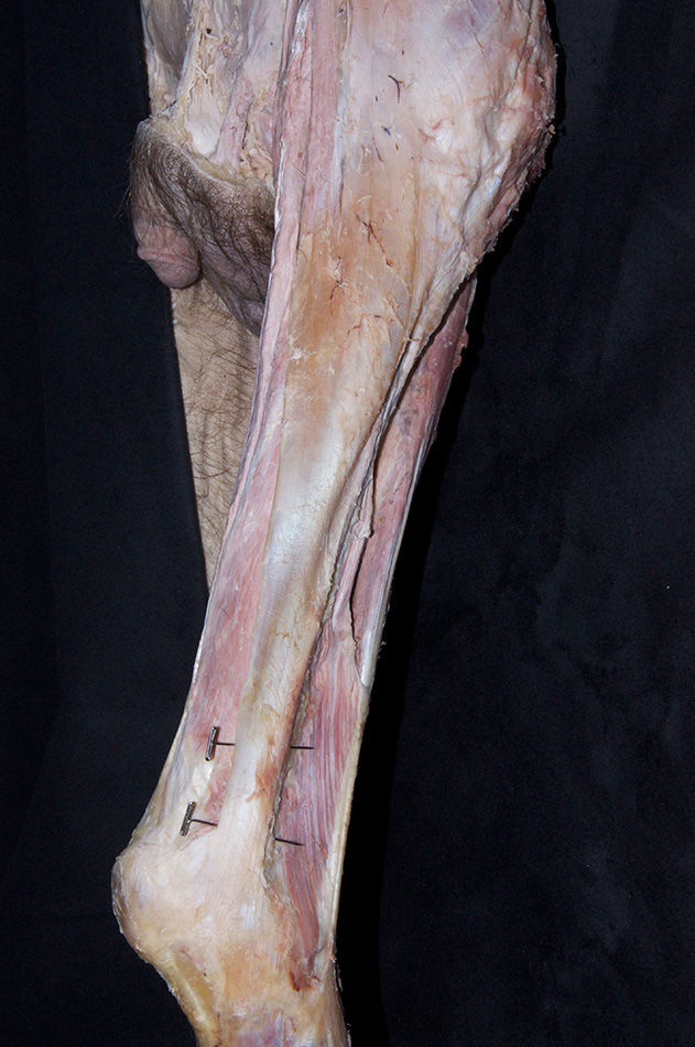 Iliotibial Tract