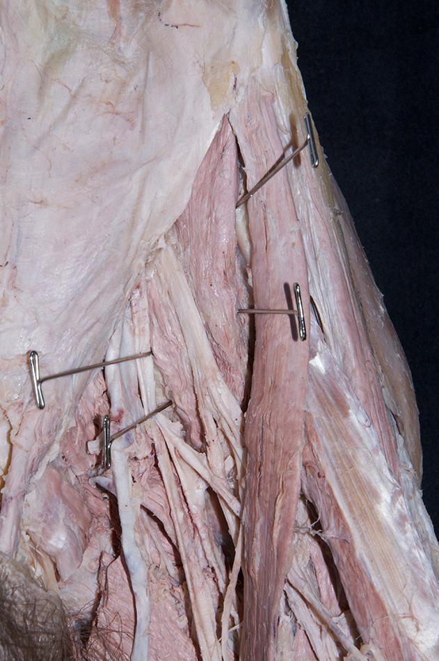 Profunda Femoral Artery (with femoral artery retracted)