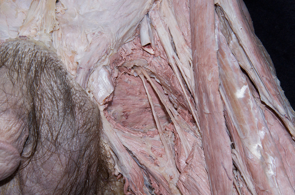 Obturator Externus Muscle