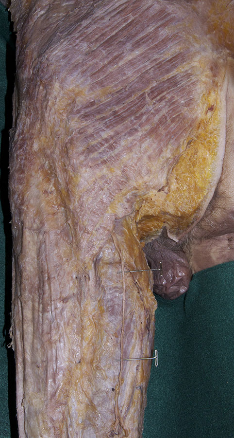 Posterior Femoral Cutaneous Nerve