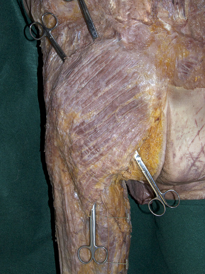 Border of the Gluteus Maximus