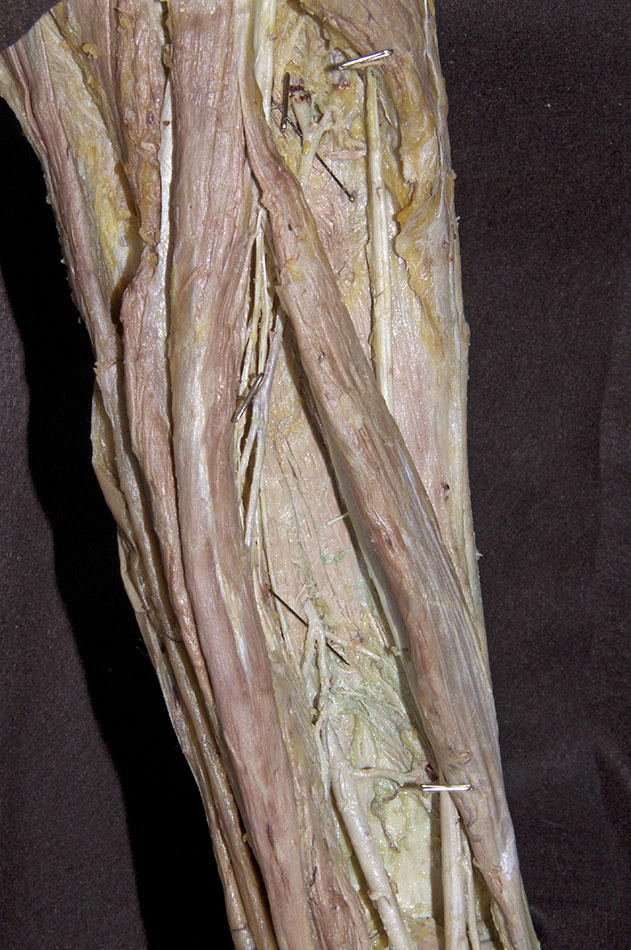 Perforating Arteries