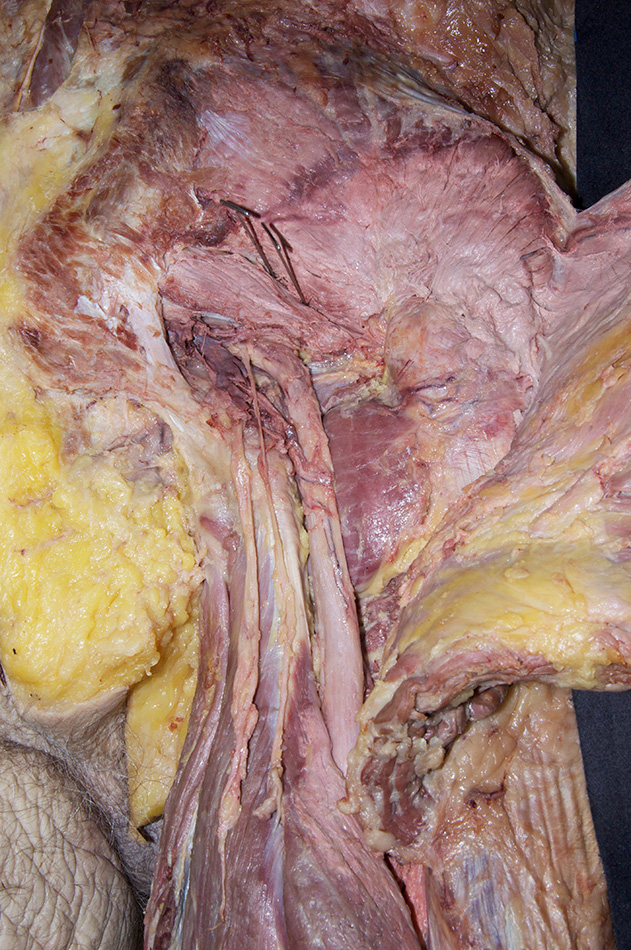 Gluteus Medius Muscle