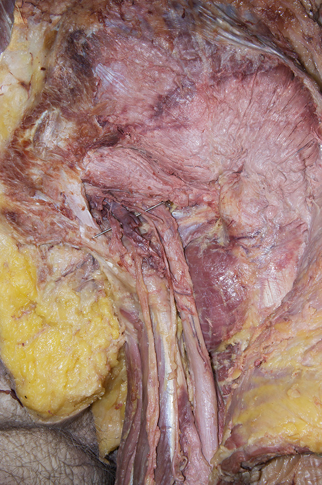 Inferior Gluteal Nerve and Artery