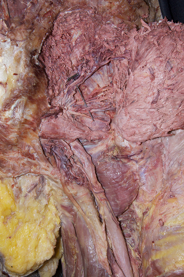 Gluteus Minimis Muscle