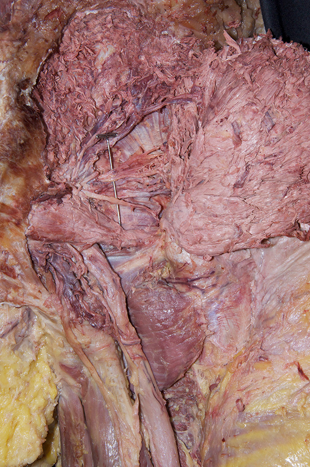 Superior Gluteal Nerve