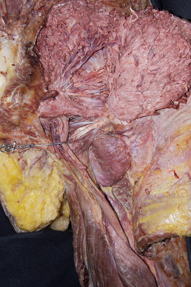 Obturator Internus Tendon