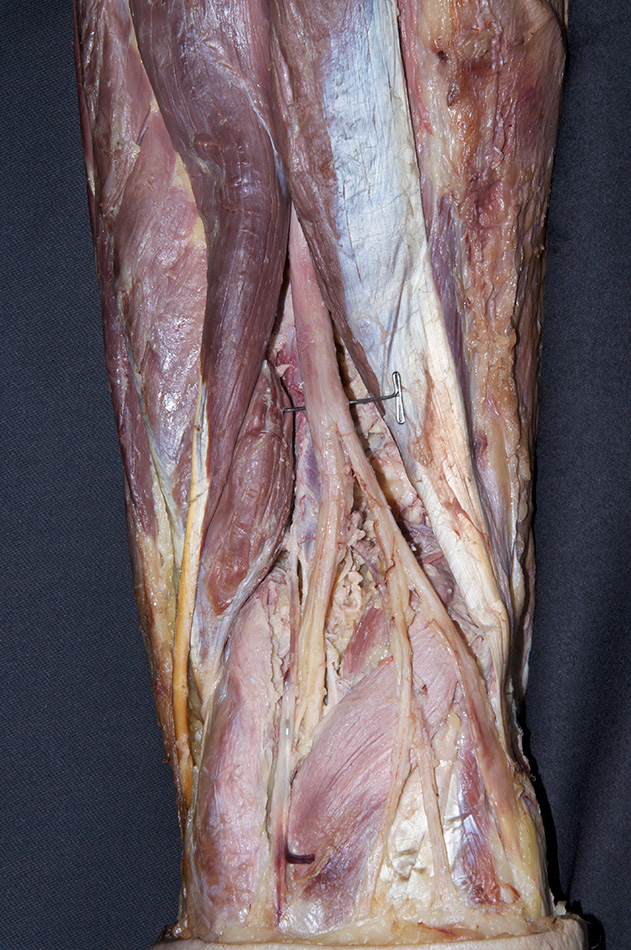 Sciatic Nerve Terminal Branches