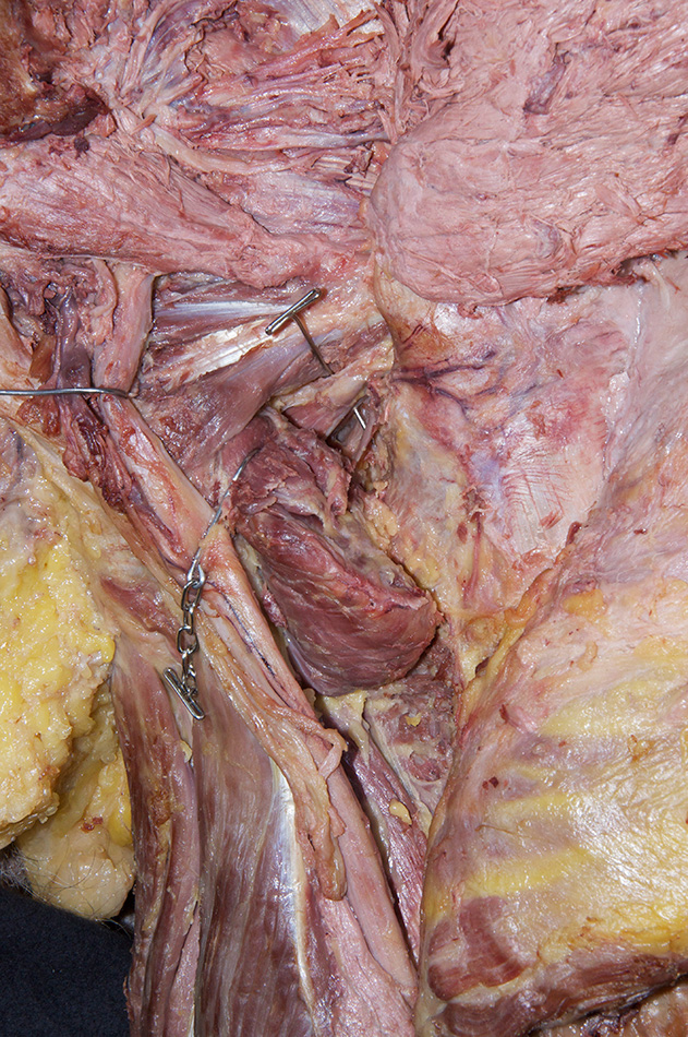 Obturator Externus Tendon