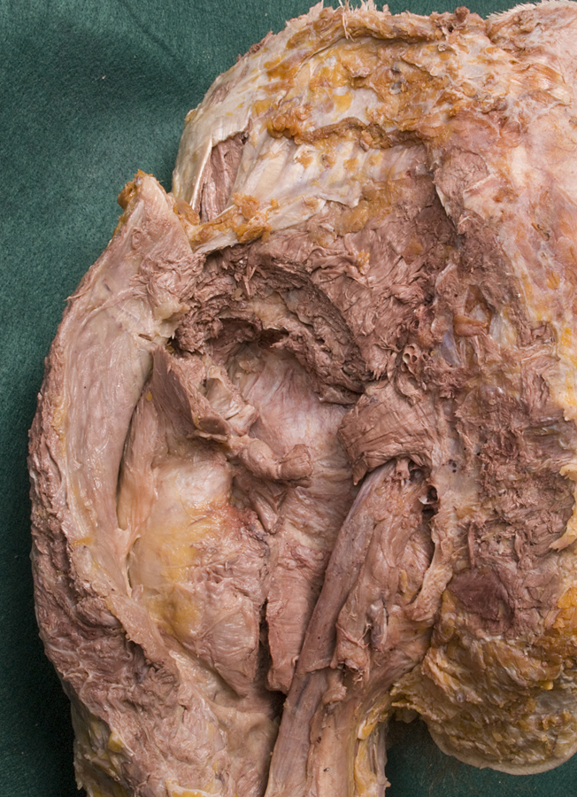 Posterior Hip