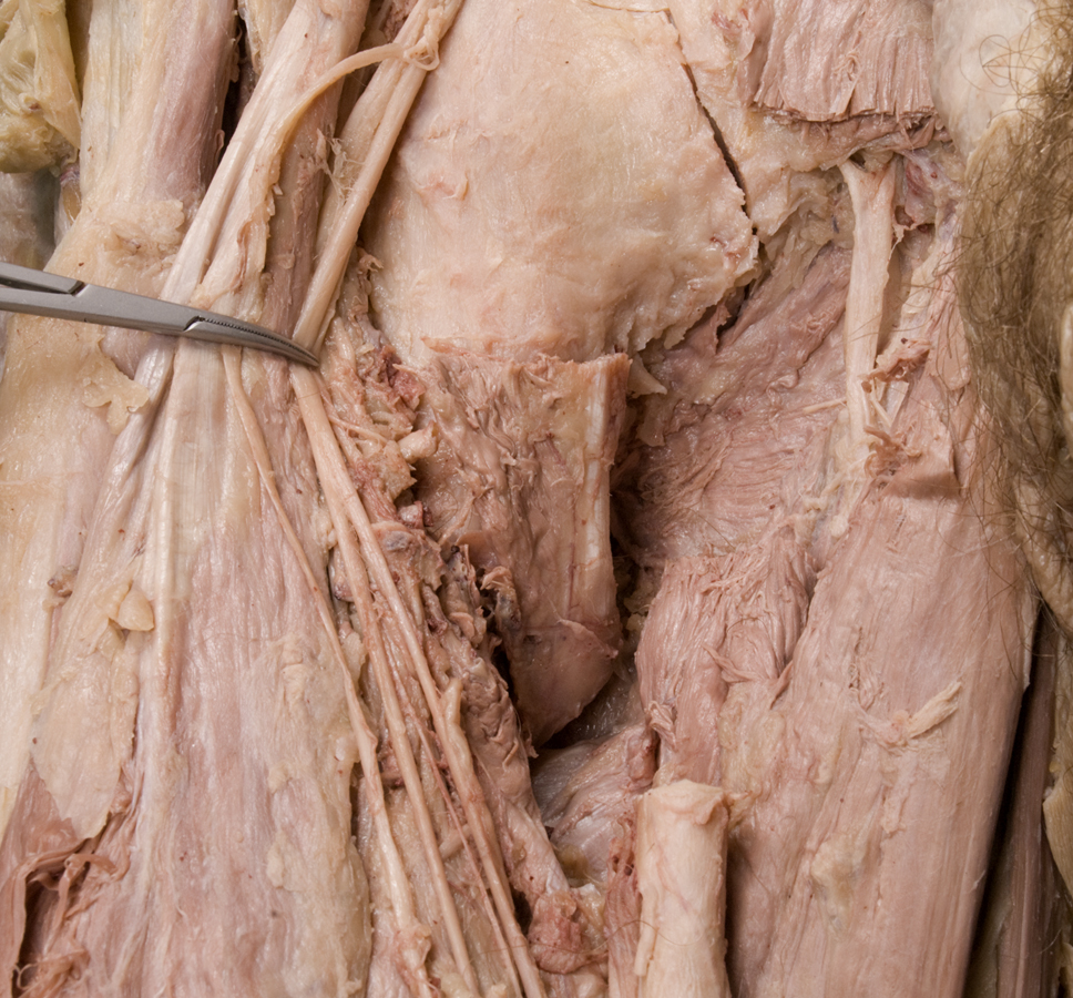 Iliopsoas Tendon