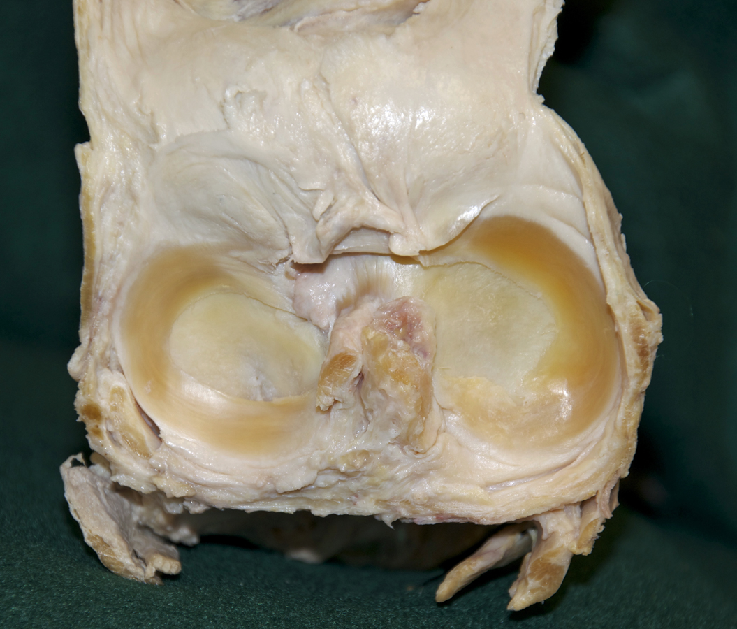 Medial and Lateral Menisci