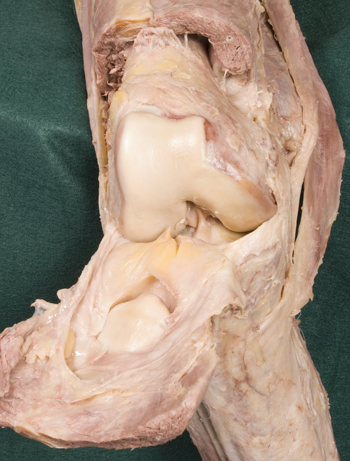 Anterior Cruciate Ligament