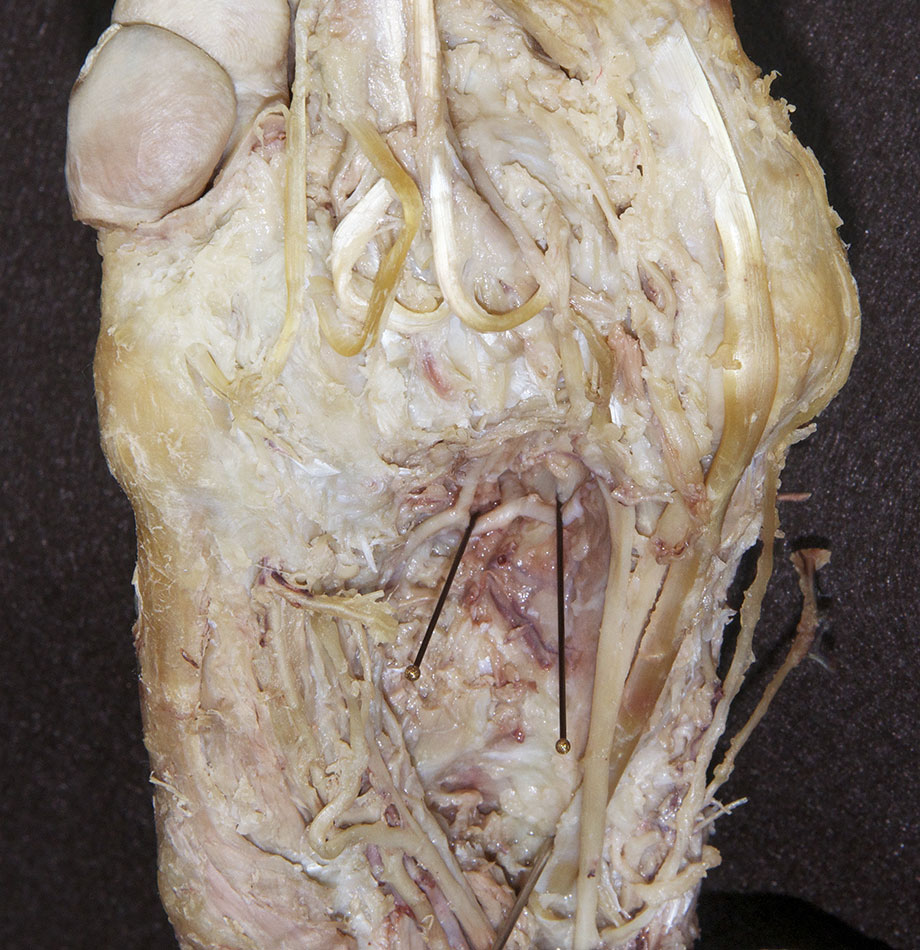 First Perforating Artery