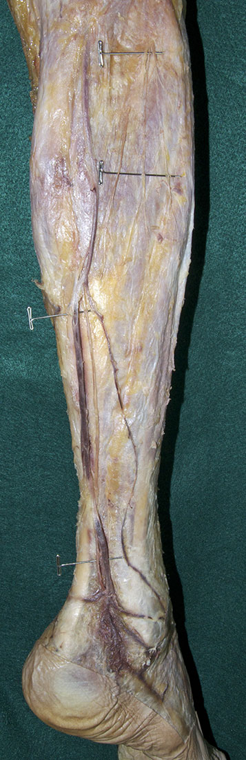 Sural Nerve