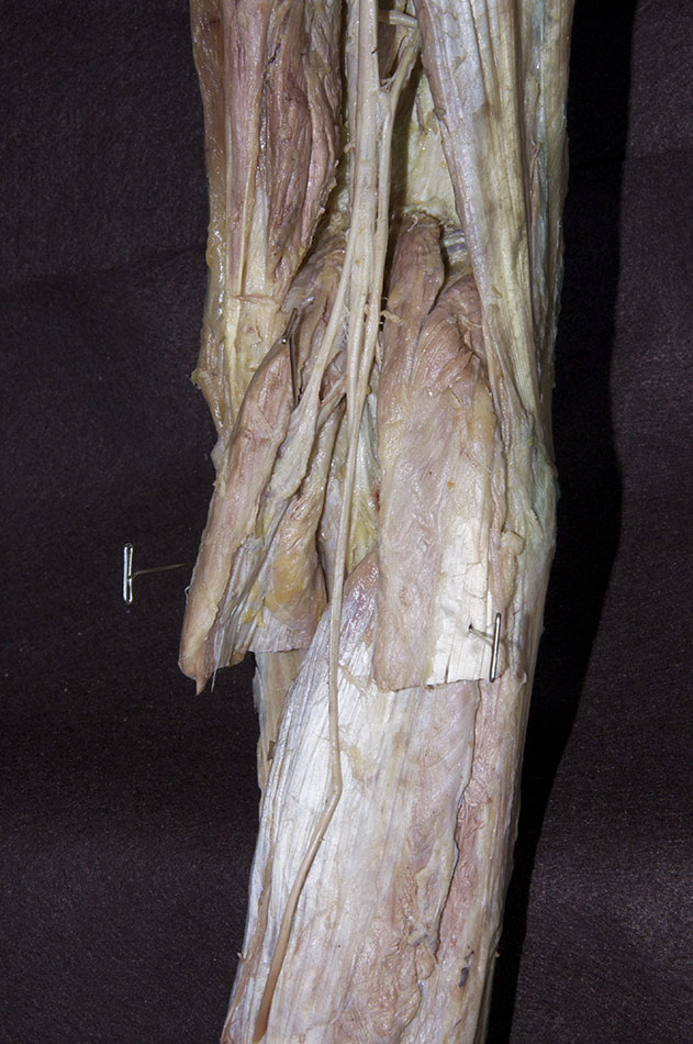 Transected Gastrocnemius Muscle