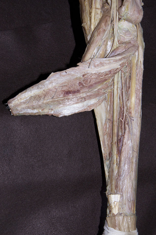 Reflected Soleus Muscle