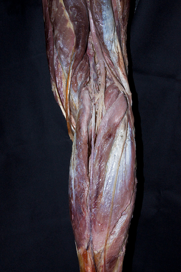Gastrocnemius Muscle