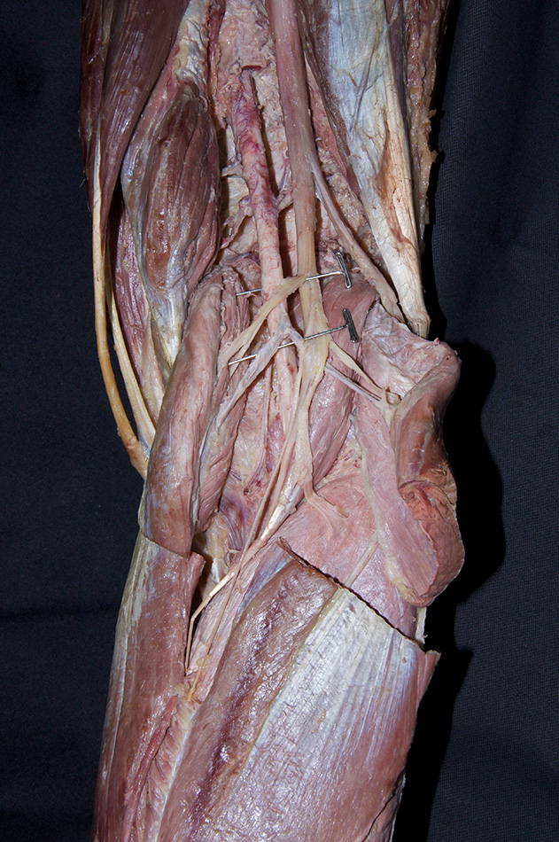 Sural Arteries